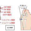 当院の外反母趾症例を７症例公開しました