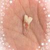 【小2息子】癒合歯を抜きました