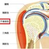 肩が痛い！肩関節周囲炎って何？？分類とそれぞれの治療法。