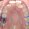 大人の歯列矯正 ⑧ 〜 ゴムはめ。矯正スタート 〜