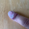 指挟んで膿んできた(´•ω•̥`)
