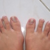 Hammer Toe Shortening Surgery