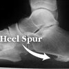 Ways To Identify Calcaneal Spur