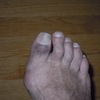 Hammer Toe Producing Ball Of Foot Pain