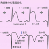 心筋梗塞における心電図の推移