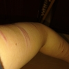 私の腕の傷