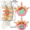 Bạn biết gì về bệnh thoát vị đĩa đệm lưng