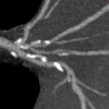 “Coronary Artery Calcification”「冠動脈石灰化」