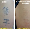 腕の自彫りタトゥーのインクを取りました