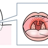 溶連菌感染症とは？大人もうつります。茅ヶ崎ファミリークリニックからの提言です。