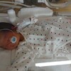 おちびくん生後4日目 ＮＩＣＵ