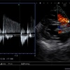 心エコー。肺動脈弁逆流（PR）。肺動脈弁逆流速波形から得られる情報。