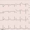 コラム-071：心電図で下壁の虚血の読み方です。(UpToDate)