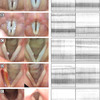 Covid-19パンデミックのロックダウン後の自発的声帯ポリープ寛解：声帯負荷は重要か？