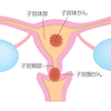 子宮頸がん後の検査に行ってきました