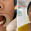 Răng sứ Cercon có ưu điểm gì so với những loại răng sứ khác?