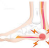 足の裏の痛み　足底腱膜炎②