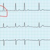 （不整脈）発作性心房細動でした