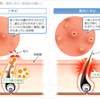 背中のブツブツ・・実は「カビ」が原因だった？！