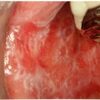 歯科金属アレルギーの症状