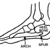 What Are The Symptoms Of Calcaneal Spur