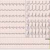 ECG-277：80才代男性。腹痛と胸部不快です。