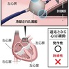 心房細動、治療の選択肢広がる