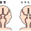 もやもや病に関する雑学！
