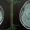 デリタクト治療、2回目のMRI撮影