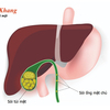 Tổng hợp 7 thông tin quan trọng nhất về sỏi ống mật chủ