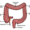 I got a Colon Polypectomy