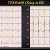 ECG-257：70才代女性。食思不振・吐き気・気分不良です。