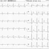 ECG-095：53才男性。胸部不快感で来院です。