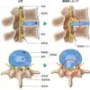 腰の疾患、ざっとまとめてみました！