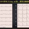 ECG-294：80才代男性。突然の胸部不快発作です。