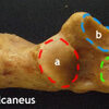 The Diagnosis Of Heel Spur