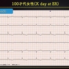 ECG-261:100才代女性。徐脈の自然経過観察でした。