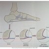 What Are The Indicators Of Calcaneal Spur
