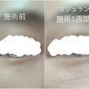 【リジュラン注射】目の下のシワにリジュランiは1回で効果あり？なし？