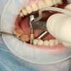 Replace Broken or Missing Tooth With Dental Implant Treatment