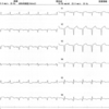 ECG-053：answer