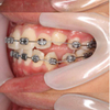 歯の隙間が無いことによる歯の萌出の遅延