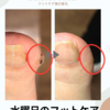 水曜日のフットケアビフォーアフター　タコがスッキリ綺麗になりました