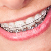 Keep Your Orthodontic Brackets Completely Tidy For A Far Better Orthodontic Treatment