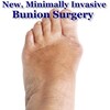 Bunion Stretches Exercise