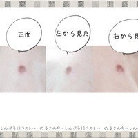 ほくろレーザー除去後の様子 顔の大きなほくろ どれくらいの期間で治る ほくろは再発する めるさんち しんぷるisベスト ほくろレーザー除去後の様子 顔の大きなほくろ どれくらいの期間で治る ほくろは再発する めるさんち しんぷるisベスト