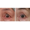 びっくり目（過開瞼）の修正手術