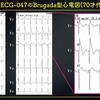 ECG-236：answer(1/2)