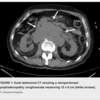 case 157：HLH（旧：血球貪食症候群）をどこでどうやって疑えるのか徹底調査！（勝手にcase series）