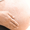 Bị chàm khi mang thai điều trị như thế nào?